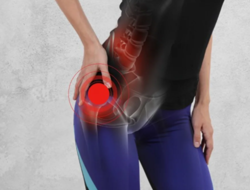 mujer con animación de dolor de cadera