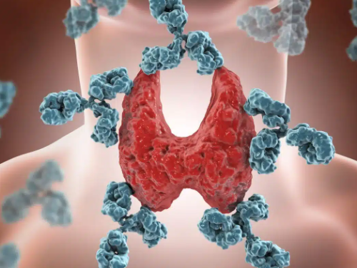 animación que representa el tiroiditis de hashimoto