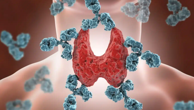 animación que representa el tiroiditis de hashimoto