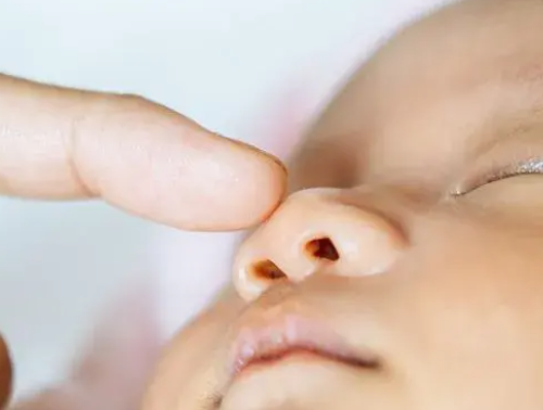 bebé con galactosemia